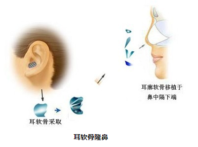 【医美小科普】隆鼻你知道多少?什么样的鼻子才算好看? 图片-6