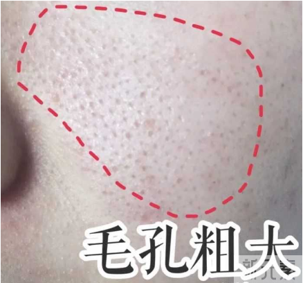女明星也逃不过的毛孔粗大、橘皮脸，该怎么办? 图片-5