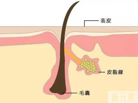 女明星也逃不过的毛孔粗大、橘皮脸，该怎么办? 图片-7