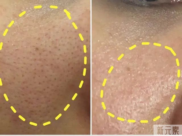 女明星也逃不过的毛孔粗大、橘皮脸，该怎么办? 图片-8