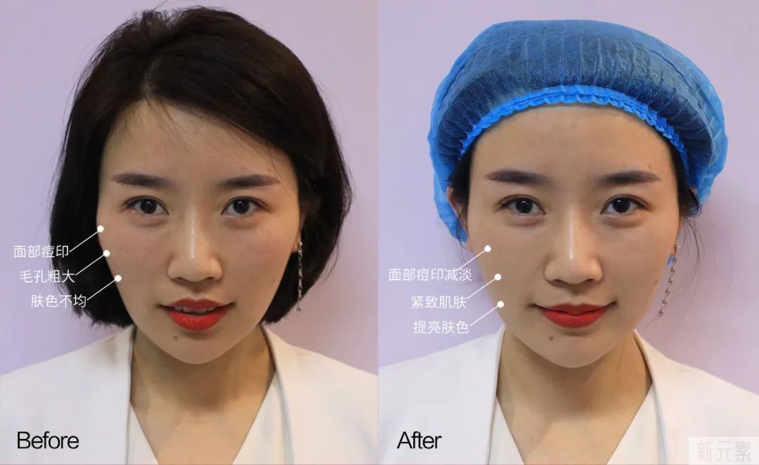 女明星也逃不过的毛孔粗大、橘皮脸，该怎么办? 图片-12
