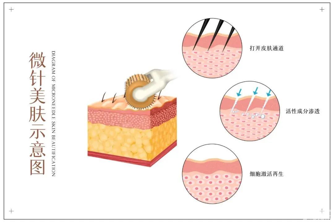 女明星也逃不过的毛孔粗大、橘皮脸，该怎么办? 图片-11