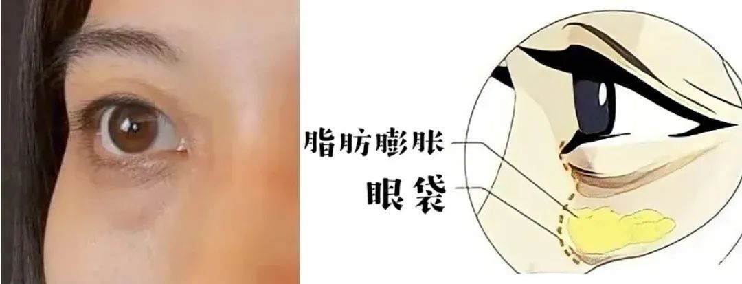 科普 | 眼袋泪沟这两大抗衰绊脚石，能一起去除吗? 图片-7