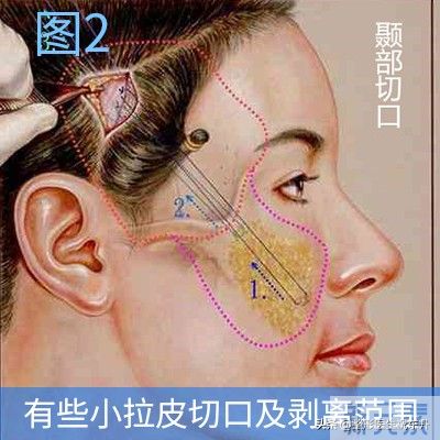 面部五层提升手术是小拉皮，还是大拉皮? 图片-2