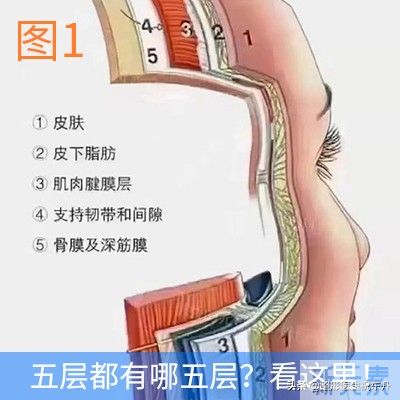 面部五层提升手术是小拉皮，还是大拉皮? 图片-1