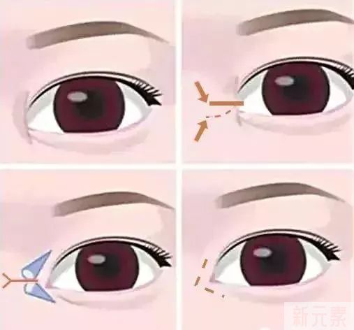 做双眼皮到底要不要开眼角? 图片-5