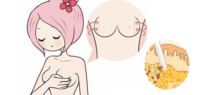 不胖的人也有副乳!它有什么影响以及如何改善? 图片-12