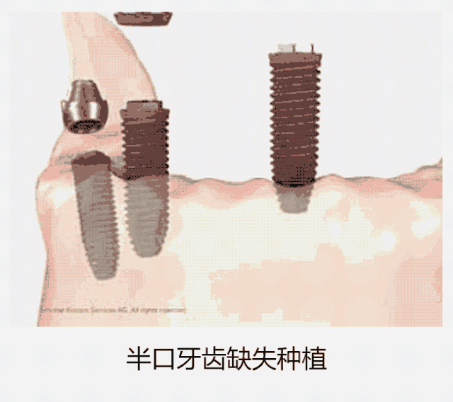 口腔里的三大“隐形炸弹”，你中了几个? 图片-16