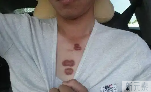 疤痕疙瘩，在不同时期的症状是怎样的? 图片-3