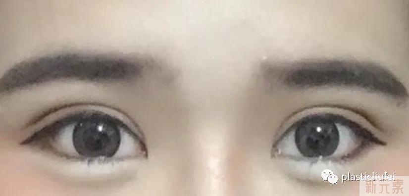 认识真实的双眼皮手术，认清医学本质，远离市场营销 图片-3