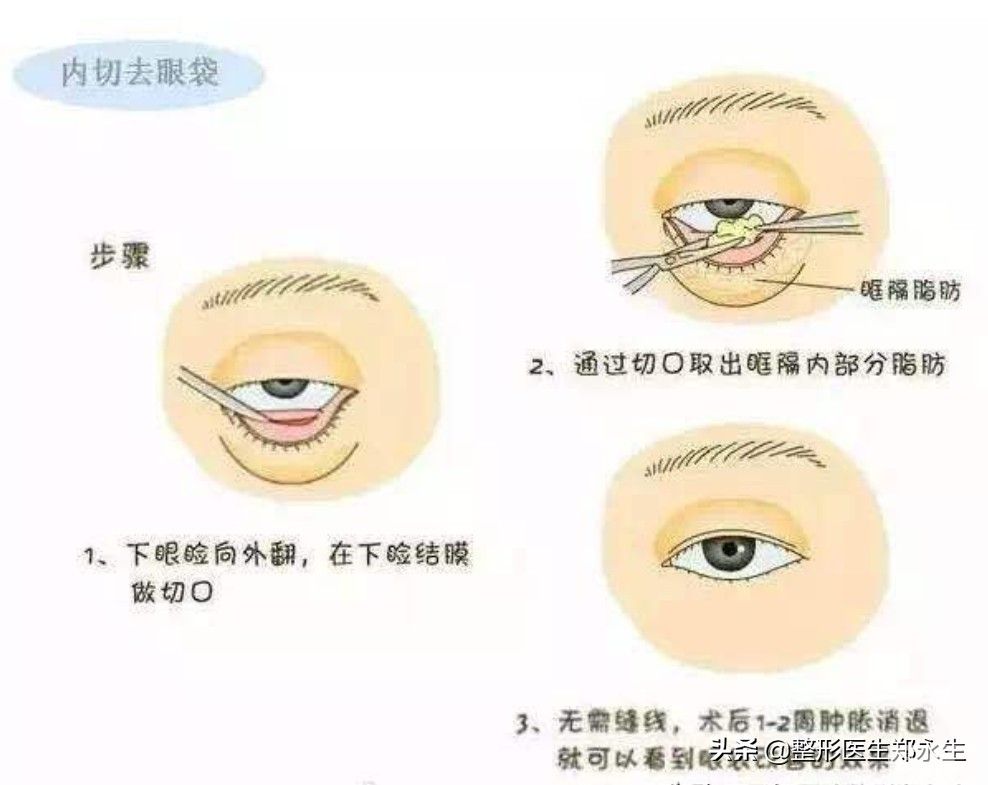 内切祛眼袋优点 图片-1