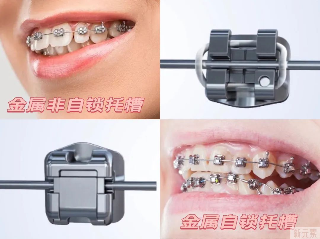 【必看】内行揭秘牙齿矫正全流程，附矫治器选择和矫正费用参考! 图片-9