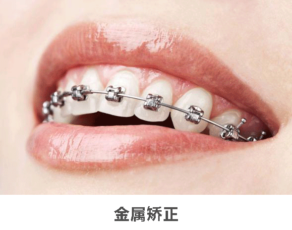 【必看】内行揭秘牙齿矫正全流程，附矫治器选择和矫正费用参考! 图片-8