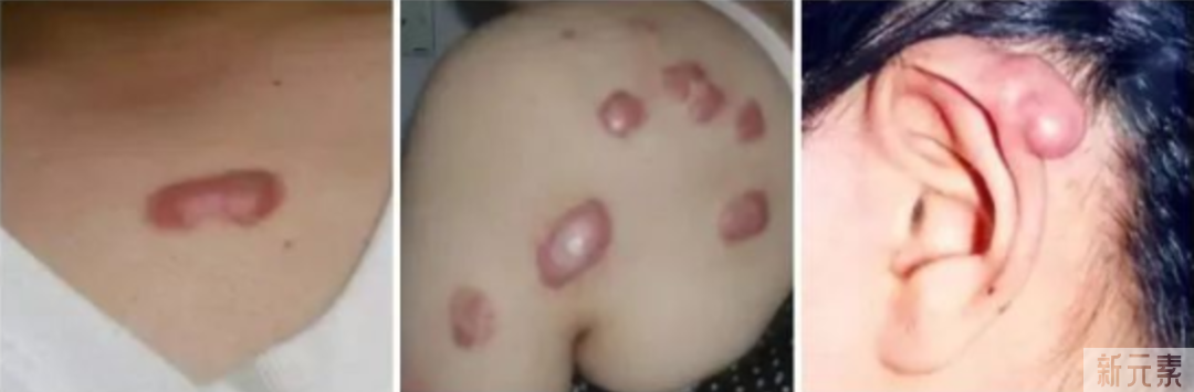 疤痕疙瘩不治疗，会一直长下去吗? 图片-6