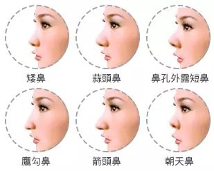 鼻整形就是隆鼻?怎么可能这么简单! 图片-13