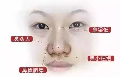 鼻整形就是隆鼻?怎么可能这么简单! 图片-7