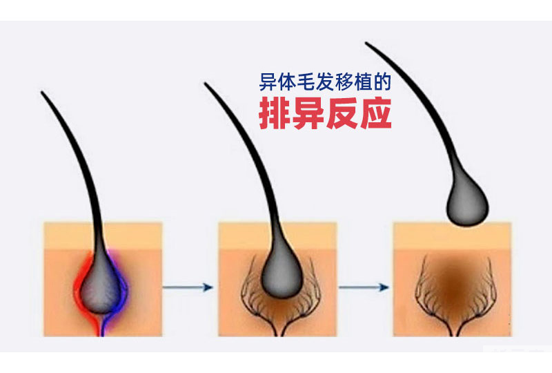 植发可以用别人的毛囊吗?可以用体毛吗? 图片-2