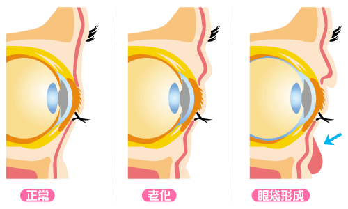去眼袋必看 | 如何安全有效去除眼袋! 图片-3
