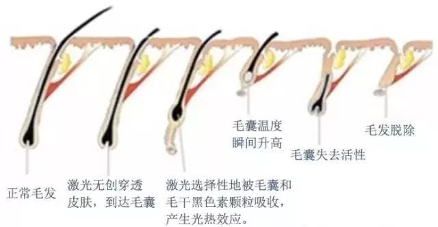 想要脱毛干净又舒适?老土的法子舍了吧 图片-14