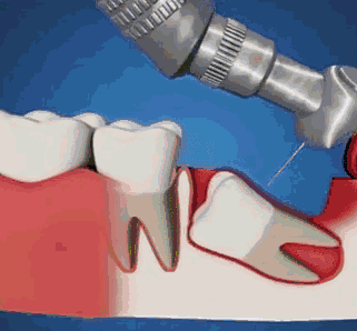 超声骨刀拔牙和普通拔牙有什么区别? 图片-14