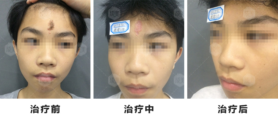 修复陈旧性疤痕，这些要点一定要记得! 图片-7