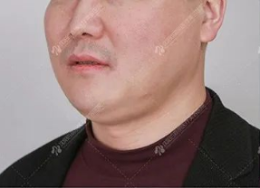 从嘟嘟肉到腰、腹、腿，你不想要的那些脂肪，这些高科技仪器轻松帮你搞定 图片-19