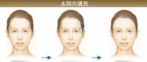太阳穴凹陷，真的不好看! 图片-11