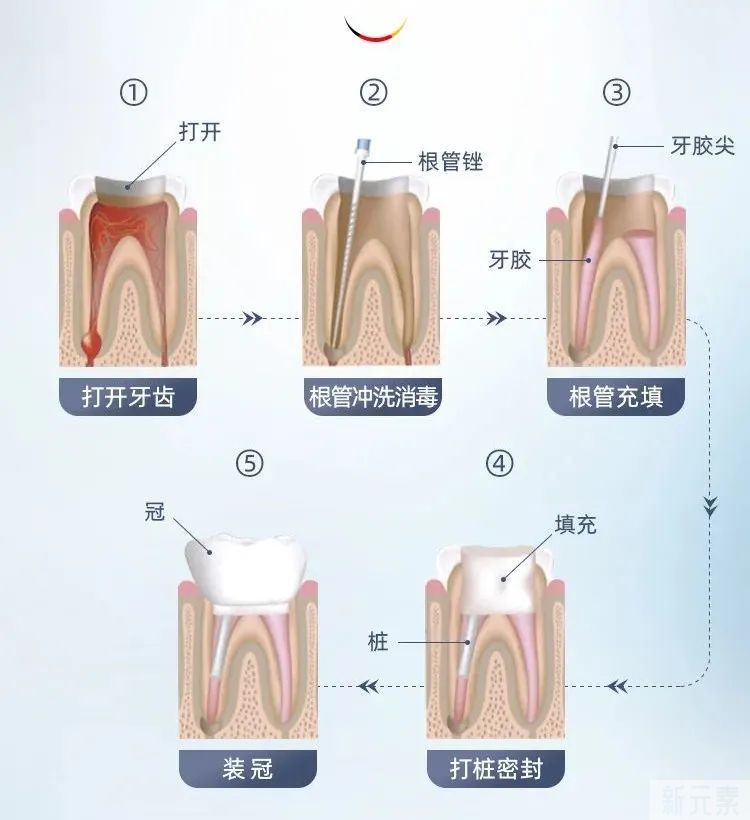 补牙治牙医生说的专业术语听不懂，此文一次给您说明白! 图片-17
