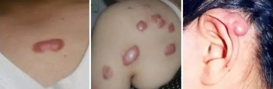 注意!疤痕疙瘩不等于疤痕体质! 图片-5