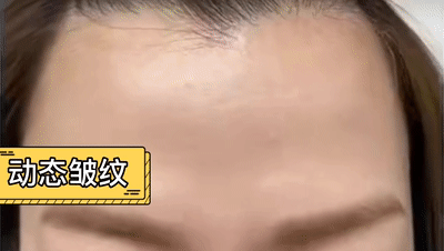 暂时性皱纹多久会变成永久皱纹? 图片-2