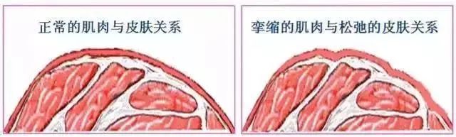 暂时性皱纹多久会变成永久皱纹? 图片-7