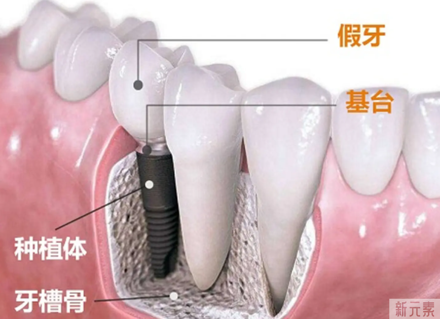 为什么大家缺牙会选种植牙? 图片-5