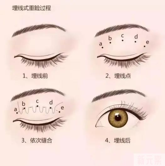 想做双眼皮手术?这些干货你要知道 图片-11