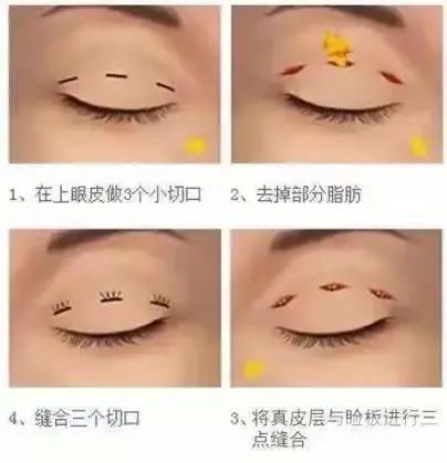 想做双眼皮手术?这些干货你要知道 图片-10