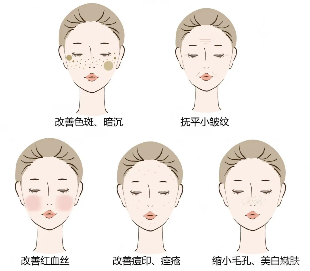 五花八门的光子嫩肤仪器，哪一种适合你? 图片-10