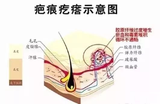 疤痕体质容易与哪些症状混淆? 图片-11