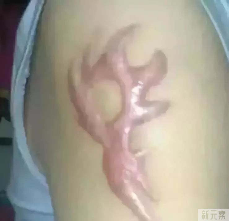 疤痕体质容易与哪些症状混淆? 图片-10