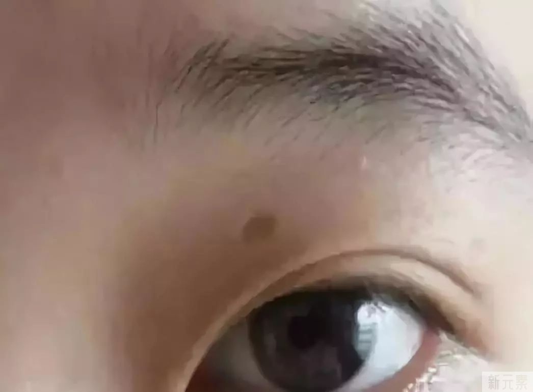 疤痕体质容易与哪些症状混淆? 图片-5