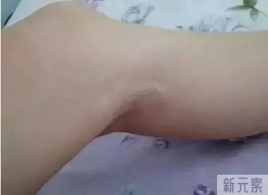 疤痕体质容易与哪些症状混淆? 图片-4