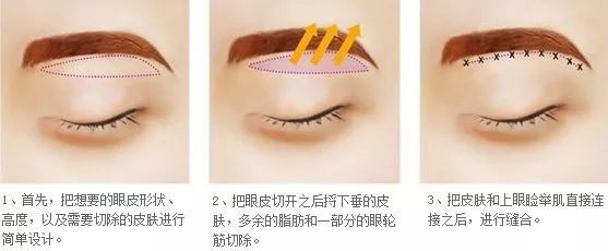 眼皮松弛?大眼袋?悬眉+祛眼袋一招搞定! 图片-3