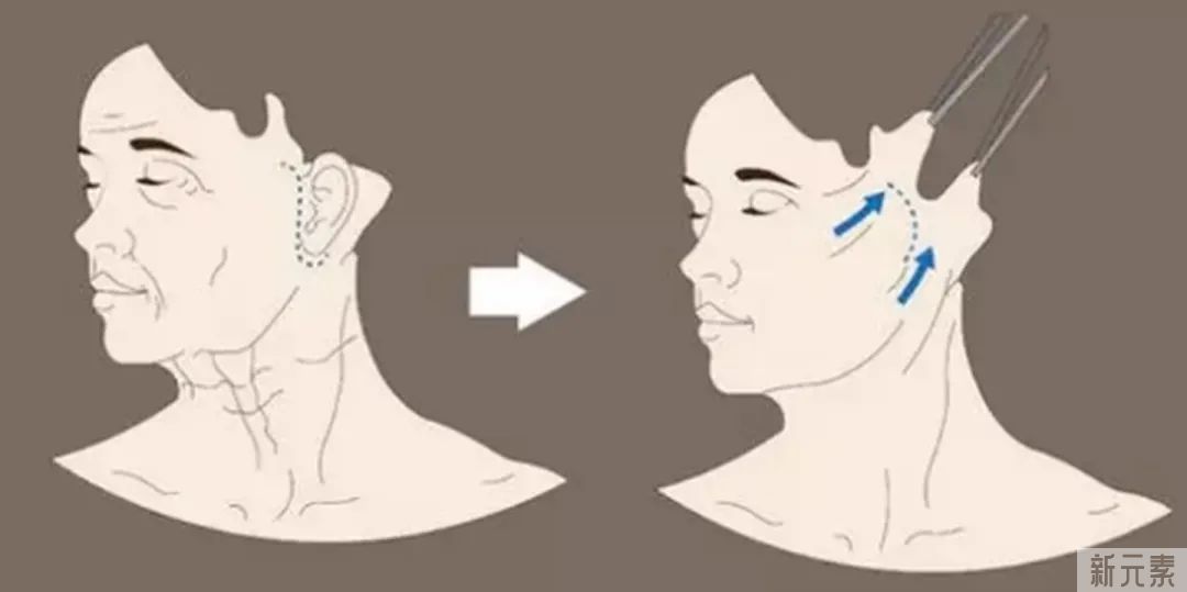 做“拉皮”手术，是不是皮肤切除的量越多越好? 图片-11