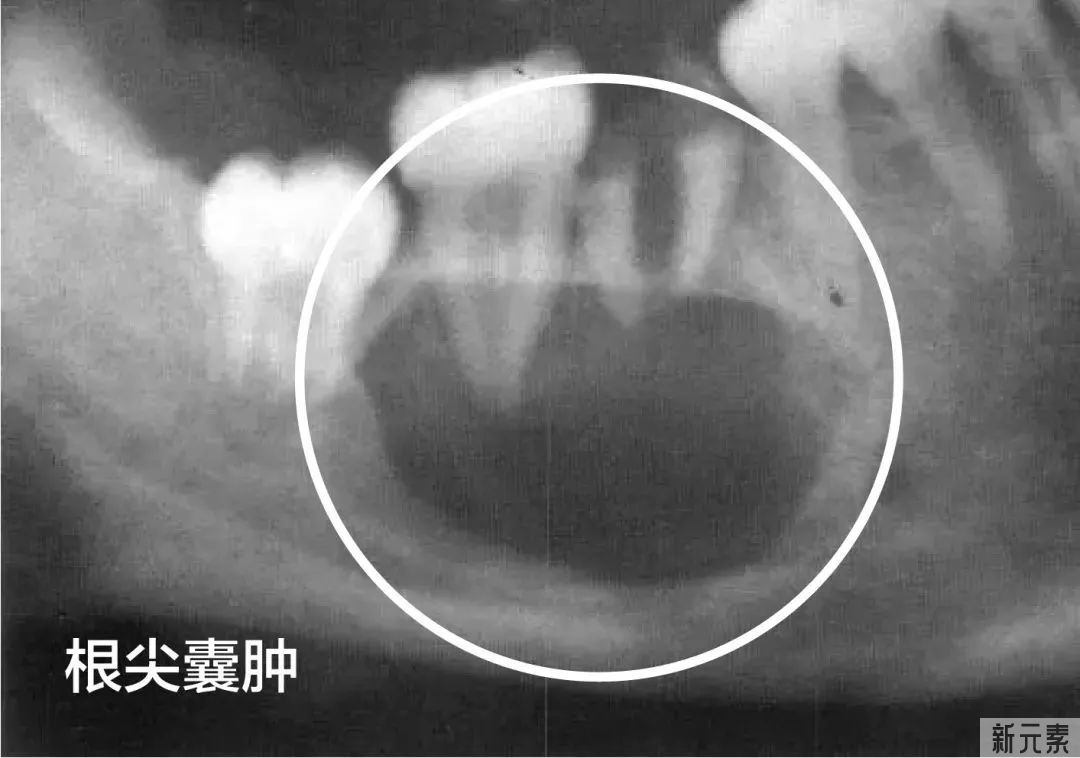残根变“祸根”?这些问题一定要警惕! 图片-9