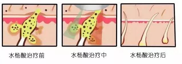 超分子水杨酸是如何治疗痤疮痘印的? 图片-8