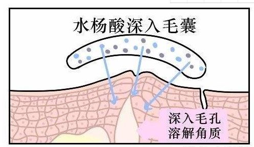 超分子水杨酸是如何治疗痤疮痘印的? 图片-3