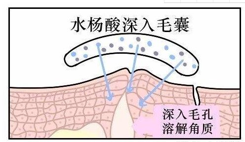 超分子水杨酸是如何治疗痤疮痘印的? 图片