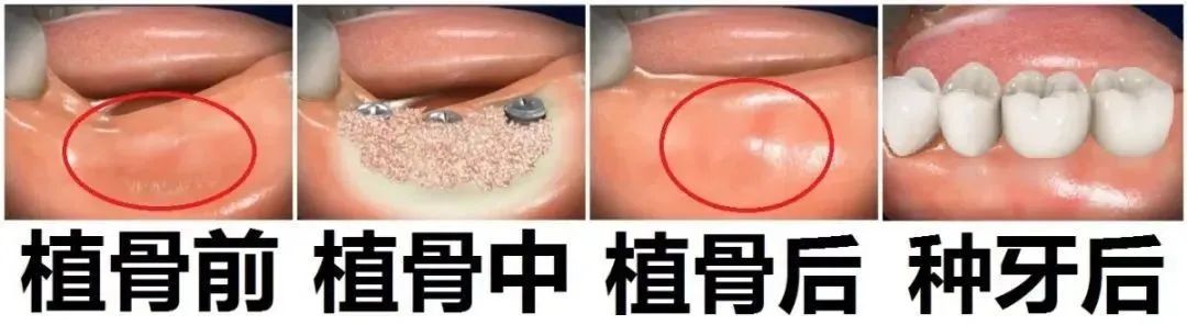 “明明是做种植牙，为啥让我加骨粉?” 图片-4