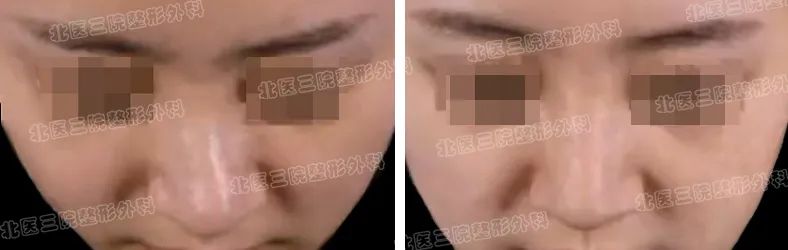 歪鼻整形，你了解多少? 图片-2