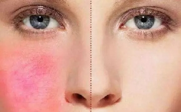 ​自己是敏感肌，适合做医美吗? 图片-4