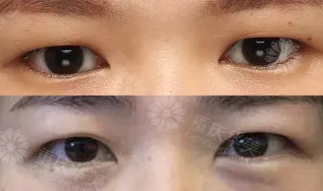 肿泡眼祛脂后眼皮还是厚厚的，难道是失败了? 图片-2