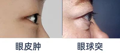 肿泡眼祛脂后眼皮还是厚厚的，难道是失败了? 图片-3